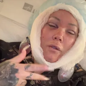 Jelly Roll's Wife Bunnie Xo Reveals Brutal Facelift Recovery