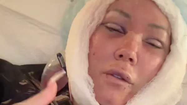 Jelly Roll's Wife Bunnie Xo Reveals Brutal Facelift Recovery