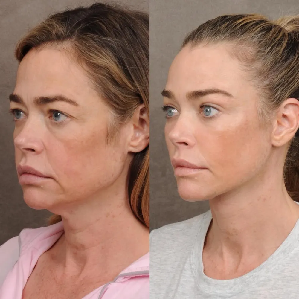 denise richards before and after facelift