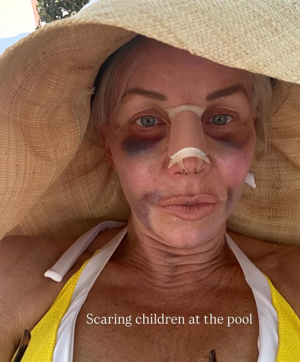 Real Housewives of New Jersey's Margaret Josephs Details 'Brutal' Bruising After Secret Nose Job
