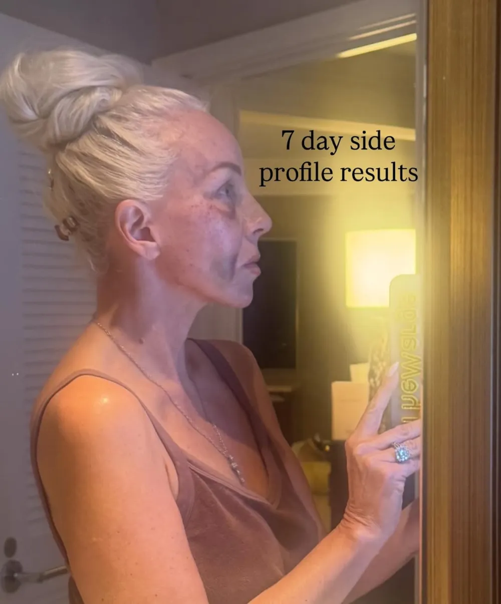 Real Housewives of New Jersey's Margaret Josephs Details 'Brutal' Bruising After Secret Nose Job