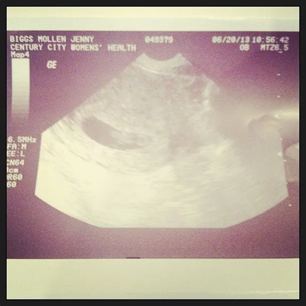 jenny mollen sonogram