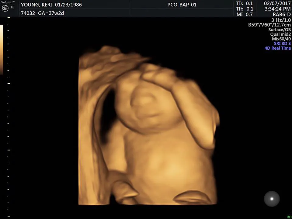 Keri Young ultrasound