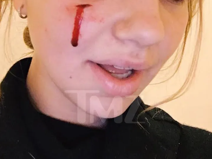 Sunny Obama's bite victim.