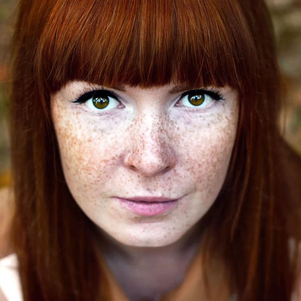 Freckles
