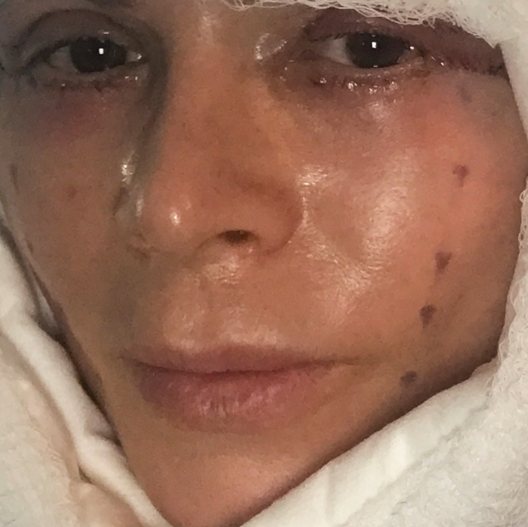 Tamra Judge facelift