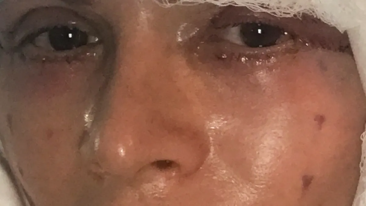 Tamra Judge facelift